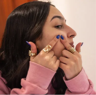 Young woman with facial acne